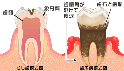 虫歯と歯周病の模式図