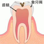 むし歯治療（一般歯科）