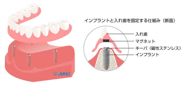 インプラントによる総義歯