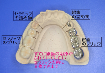 銀歯から白いセラミックの歯に交換できます