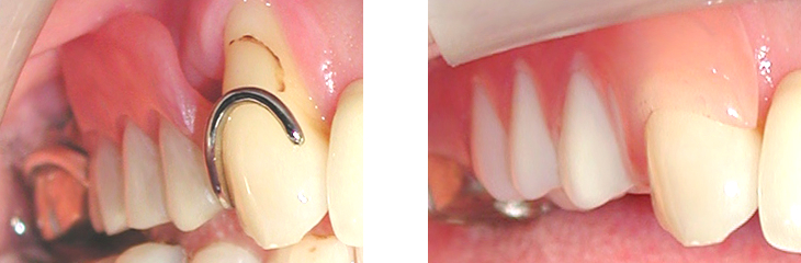 保険の入れ歯と金具のない部分入れ歯スマイルデンチャーの比較写真