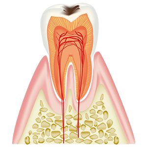 C1　エナメル質内のむし歯