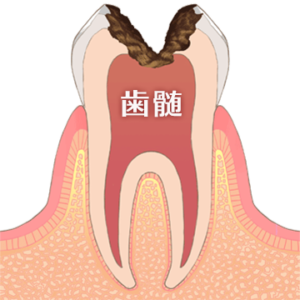 歯髄のイラスト