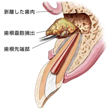 歯根端切除術のイラスト
