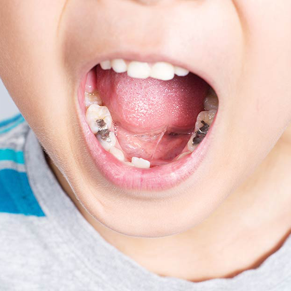虫歯治療後の口腔内